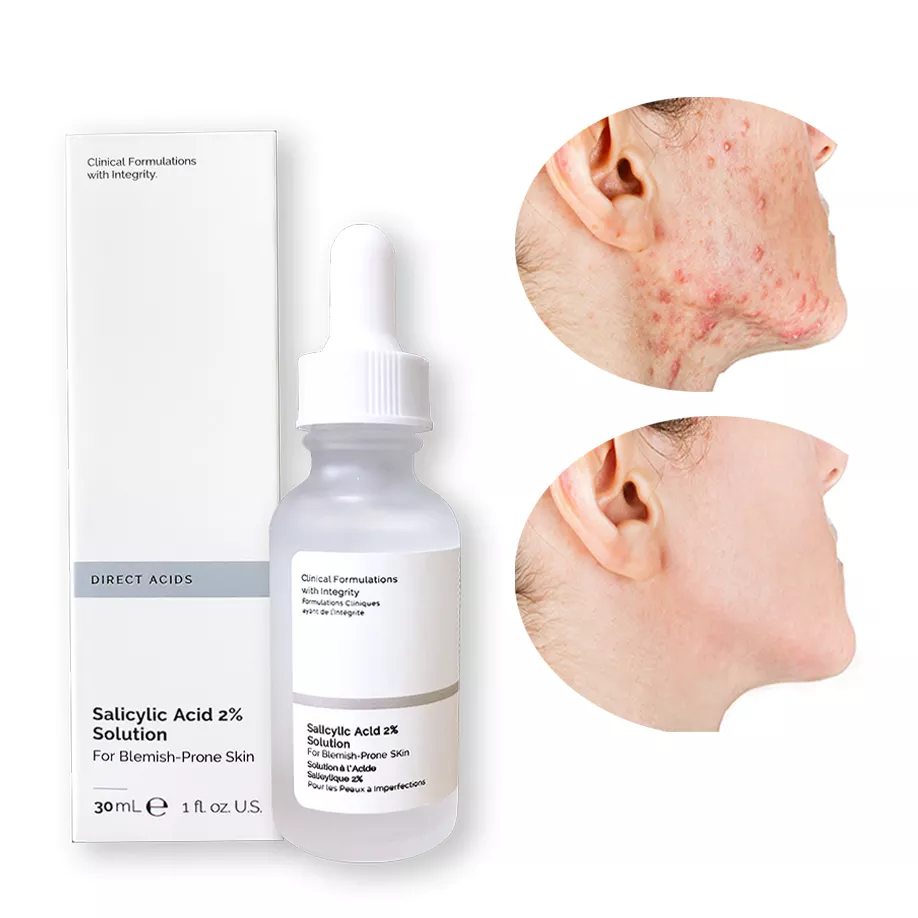 Serum pour l accne